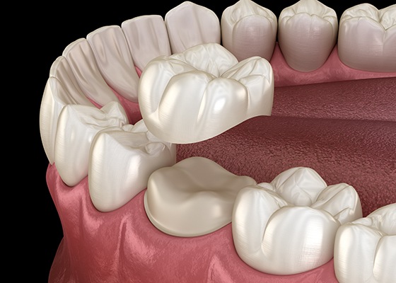 A 3D illustration of the dental crown process