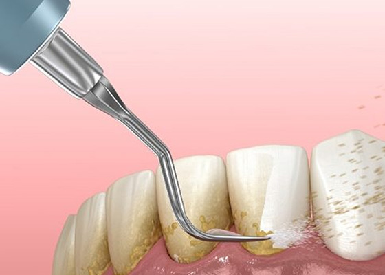 Digital image of scaling and root planing in Annapolis