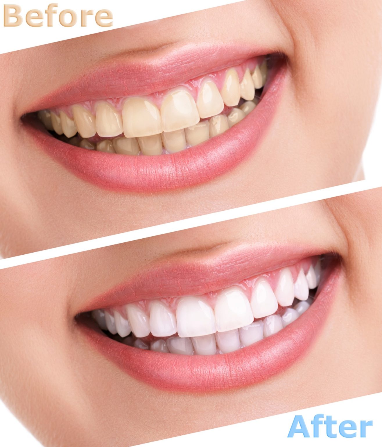 How to Whiten Bonded Teeth in Annapolis for a Brighter Smile