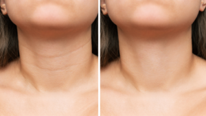 a before and after photo of a patient’s neck lines