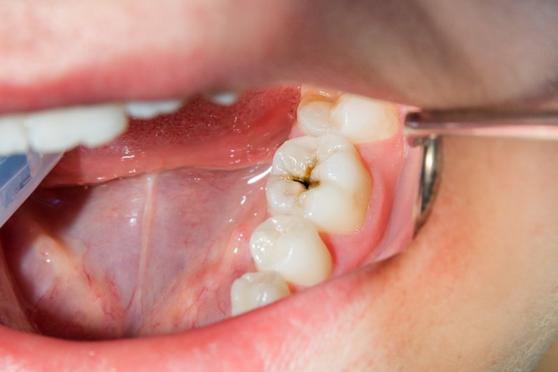 A closeup of a decayed tooth